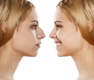 rhinoplastie